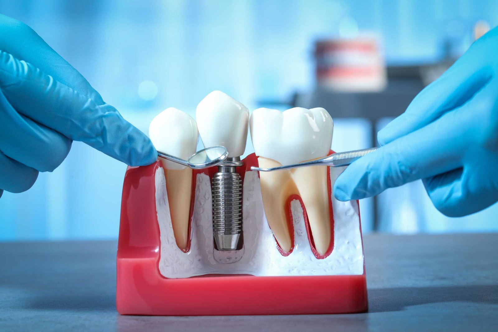 Caring for dental implants at Dhanesh Dental Care