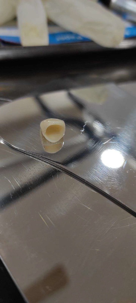Root canal procedure steps at Dhanesh Dental Care Thoothukudi
