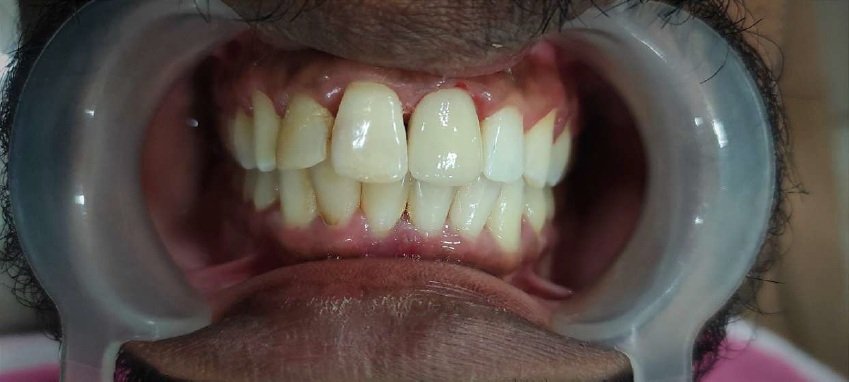 Root canal procedure steps at Dhanesh Dental Care Thoothukudi