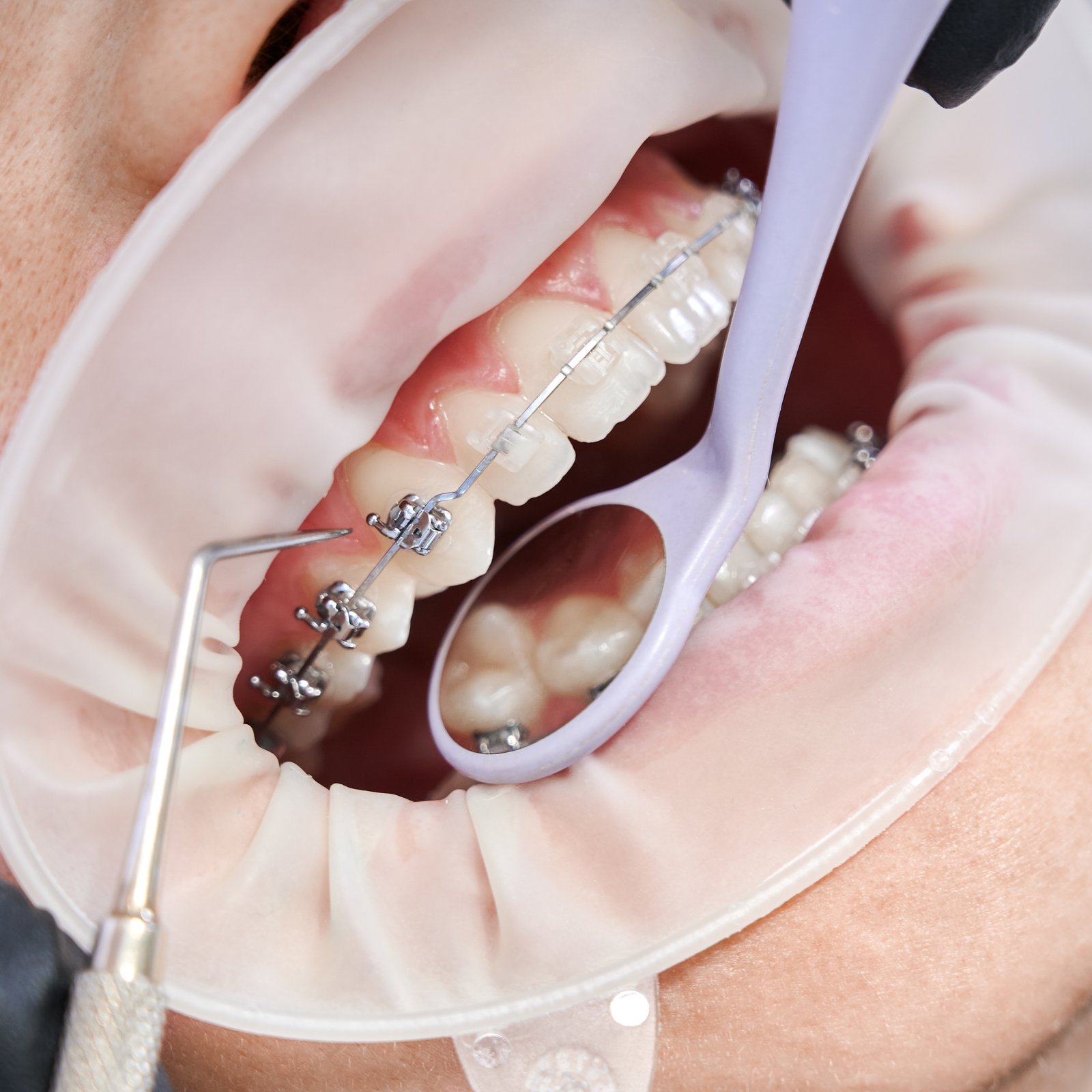 Braces treatment Thoothukudi