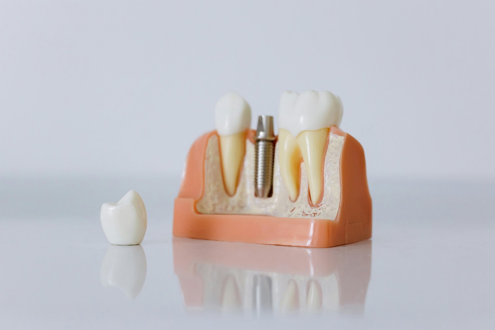 Dental implants at Dhanesh Dental Care Thoothukudi