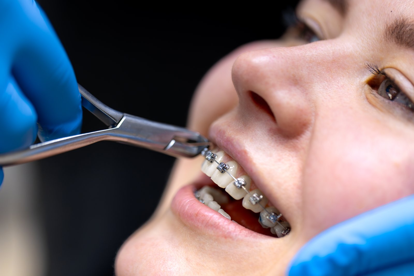 Orthodontics treatment at Dhanesh Dental Care Thoothukudi